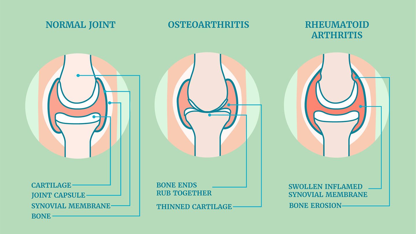 arthritis 3